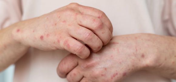 Alerta de brote de sarampión en Australia